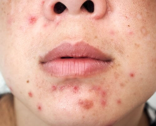 traiter l'acné par la phytothérapie